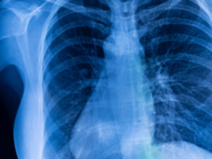 Can Artificial Intelligence help diagnose lung cancer faster?